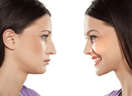 Nasal reconstruction
