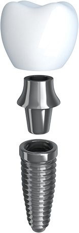 Dental Implant illustration showing the different parts