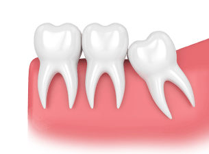 Wisdom Teeth
